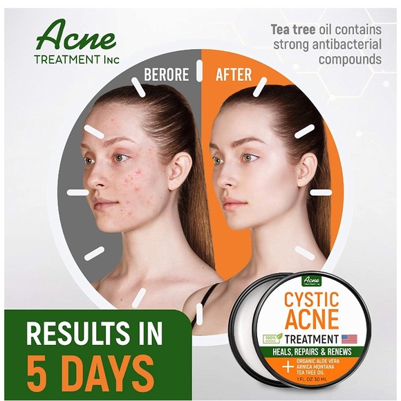 aeno acne